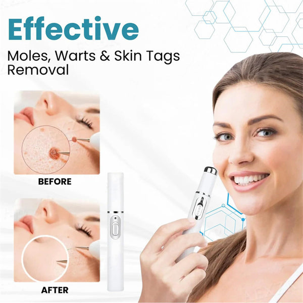 Mole & Wart Removal Pen